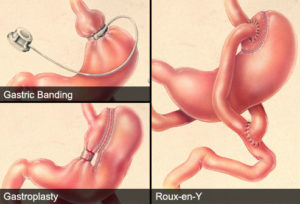 gastric bypas1